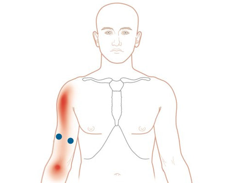 Points de déclenchement des biceps