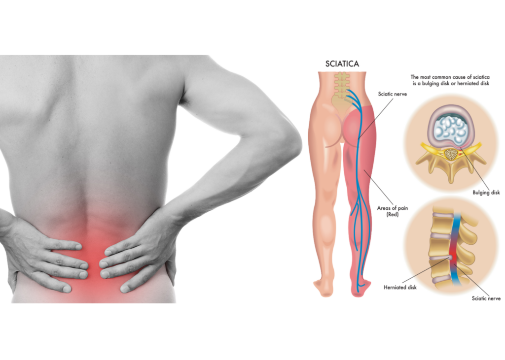 Qu'est-ce que la douleur sciatique et comment l'éviter