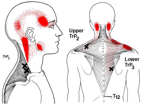 douleur myofasciale