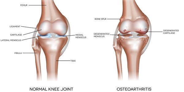 Genou normal comparé au genou arthrosique.  Physiothérapie de l'arthrose du genou et rééducation par remplacement du genou.  Propulser la physiothérapie