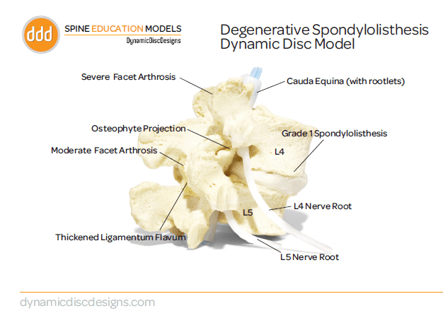 spondylolisthésis