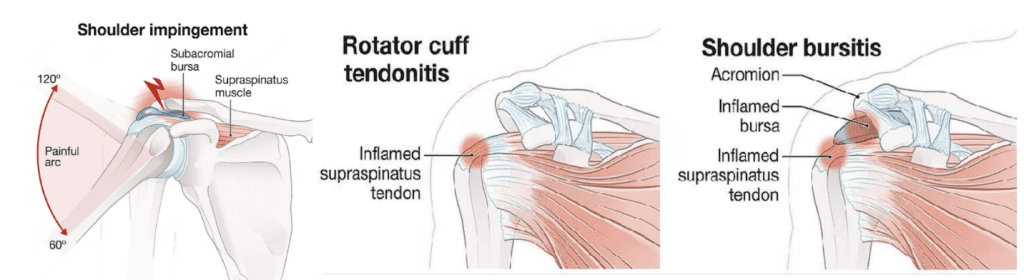 blessure à la coiffe des rotateurs