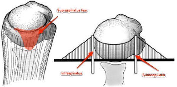 déchirure de la coiffe des rotateurs